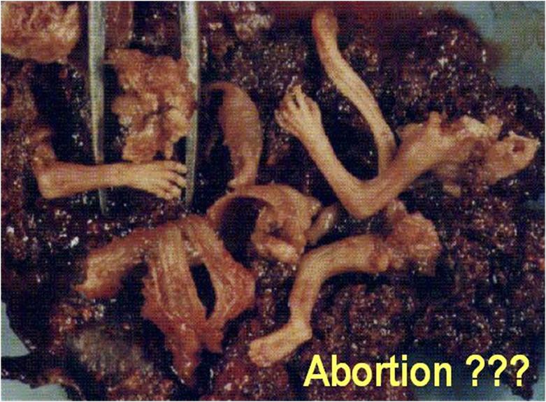 Abortion